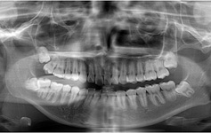 写真：下顔面パノラマレントゲン検査