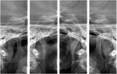 写真：顎関節レントゲン検査