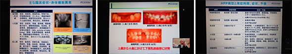 2021年8月25日　低ホスファターゼ症　ウエブ講習会