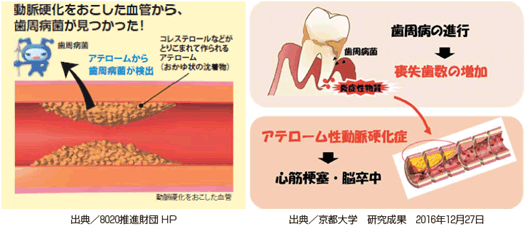 動脈硬化をおこした血管から、歯周病菌がみつかった！