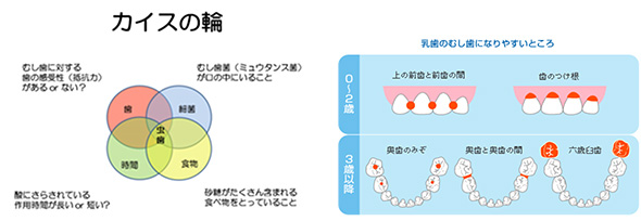 カイスの輪　乳歯のむし歯になりやすいところ